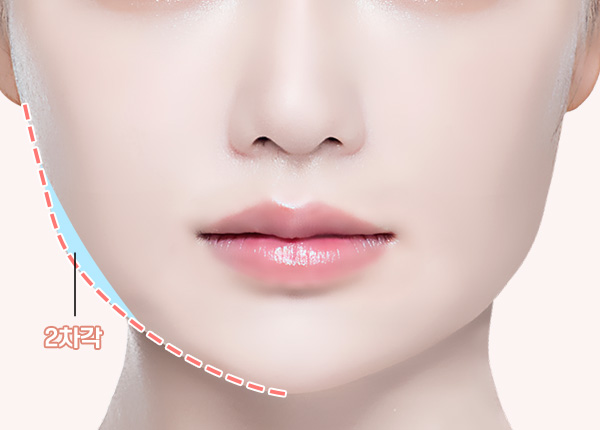 사각턱/광대 교정 | 온유성형외과
