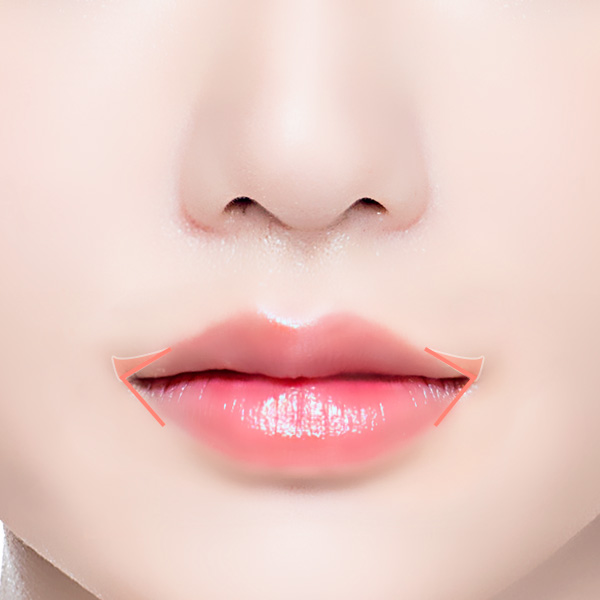 입꼬리성형 | 온유성형외과